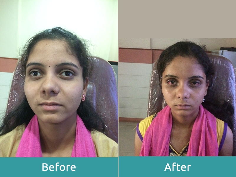 Squint Treatment Dr Bhange Eye Hospital 