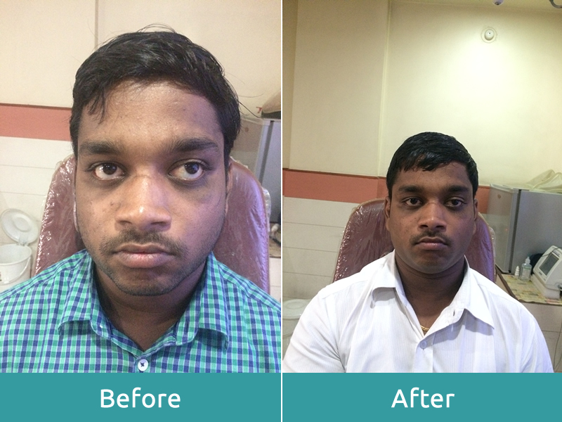 Squint Treatment Dr Bhange Eye Hospital 