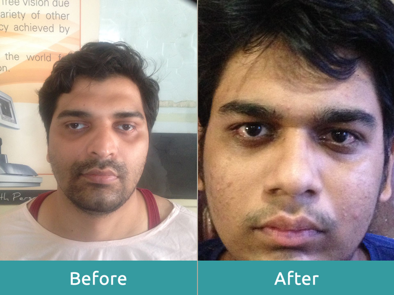 Squint Treatment Dr Bhange Eye Hospital 